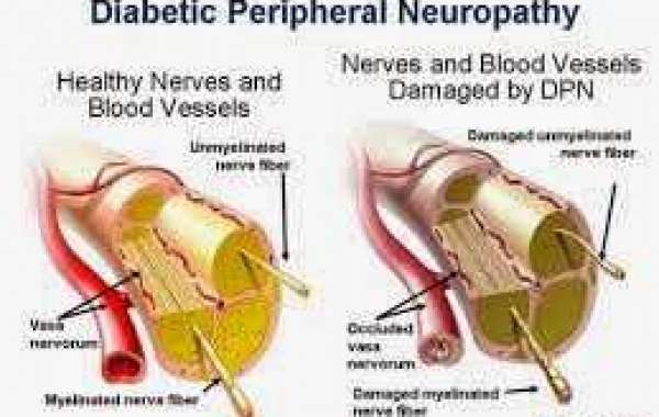 Diabetic neuropathy ဆီးချိုကြောင့်ဖြစ်ရတဲ့ အာရုံကြောရောဂါ