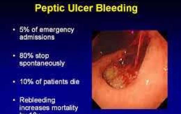 Bleeding Peptic Ulcer အစာအိမ်နာ သွေးယိုခြင်း