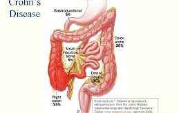 Crohn’s Disease ခရုန်းရောဂါ