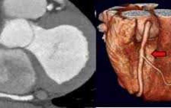 CT coronary angiogram နှလုံးသွားသွေးကြောများ CT ရိုက်ခြင်း