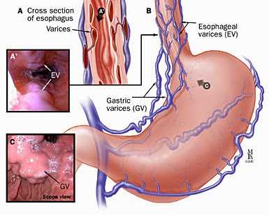 Esophageal varices 